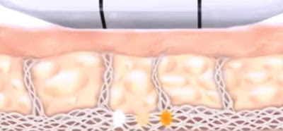 Ultrassom Microfocado para tratar flacidez: o lifting sem cirurgia